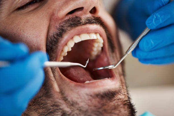 Best Chipped Tooth Repair Near Me  in Butler, NJ